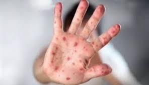 Kadiskes Sebut Virus Mpox Belum Terdeteksi di Riau
