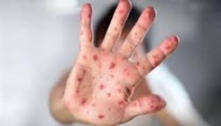 Kadiskes Sebut Virus Mpox Belum Terdeteksi di Riau